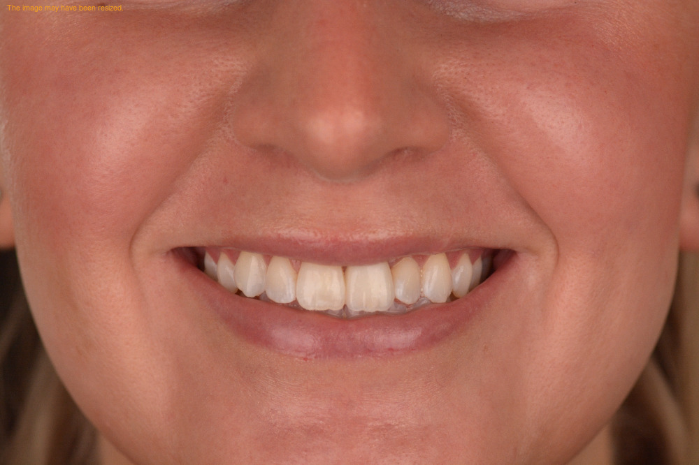 Replacing a Single Front Tooth: The Hardest Case in Dentistry