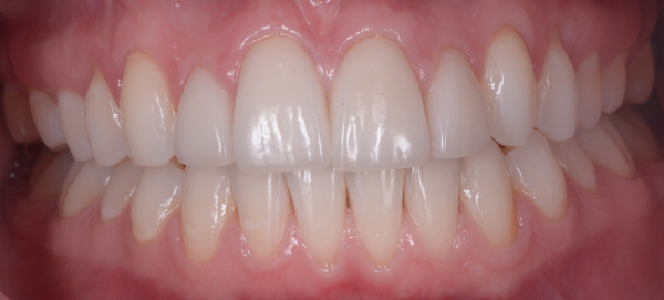 LS After Veneers