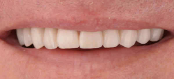 RH Before Veneers-1