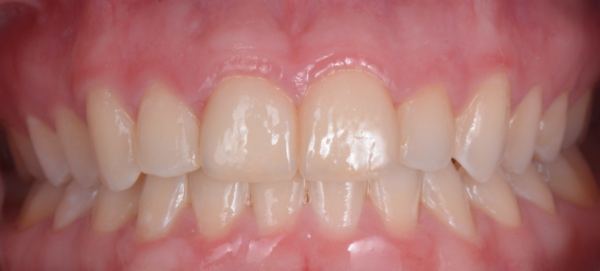 RW After Veneers